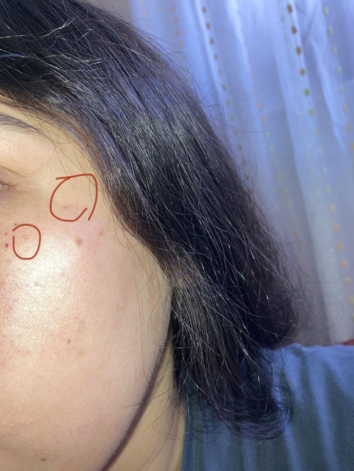 Yüzüme ağda yapınca tahriş oldu ve lekeler oluştu. Bu lekeler gider mi?