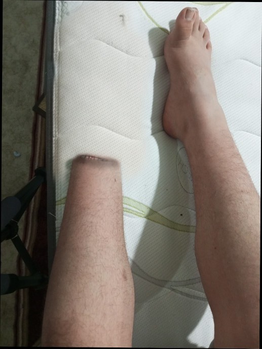 Arkadaşlar ampute oldum?