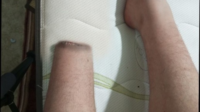 Arkadaşlar ampute oldum?