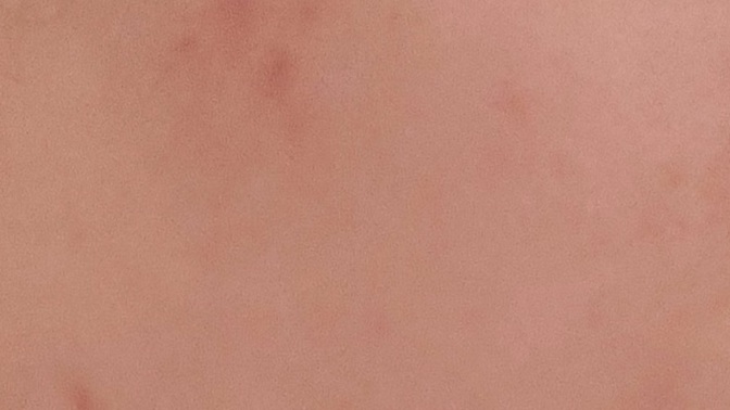 Kızlar, bu sivilce ve lekelerim sebebi ne olabilir ve nasıl geçer?