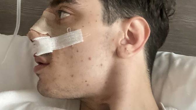 4 gün önce estetik oldum, burnum çok mu kalkık oldu?