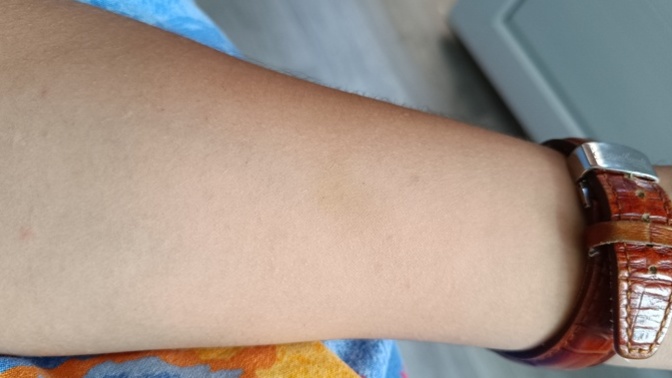 2. evre karaciğer yağlanmam var bu sarı lekelerin sebebi bu mudur buysa nasıl geçer?