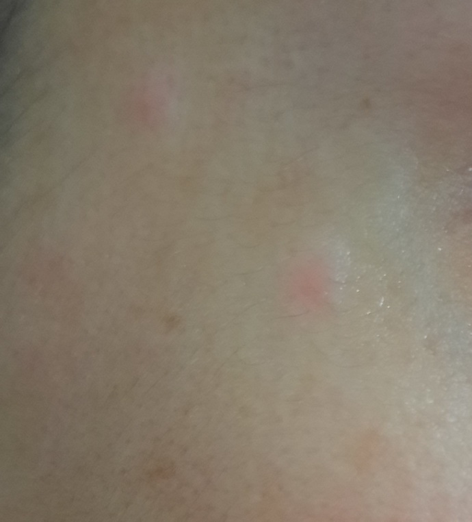 Alerji mi, sivilce mi?