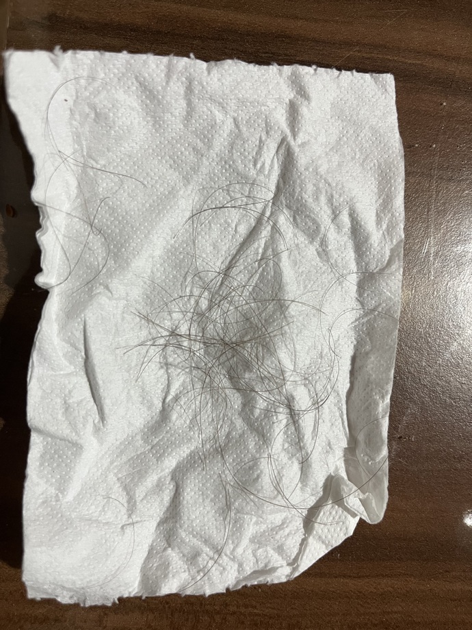 Bu saç dökülmesi normal mi?