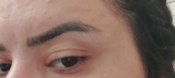 İşlem sonrası kaşım bir ay kalmadan siliniyor, siz olsanız ne yaparsınız?