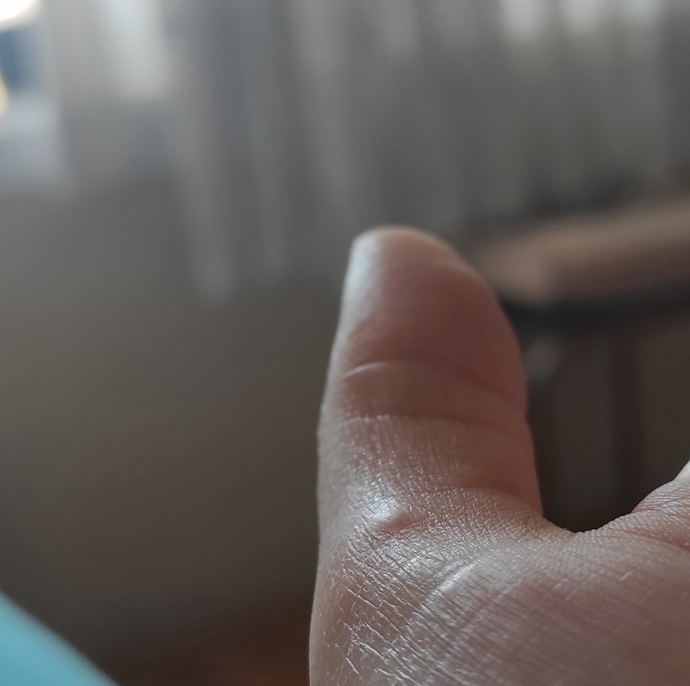 Parmağımda çıkan şişlik ne olabilir?