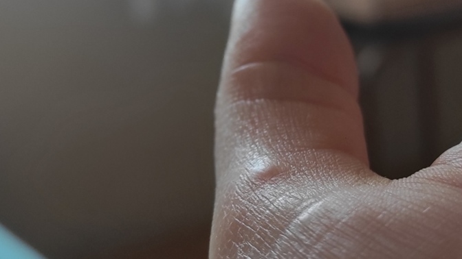 Parmağımda çıkan şişlik ne olabilir?