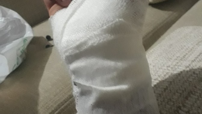 Elime dikiş atıldı. Ağrısını geçirmek için ne yapmalıyım?