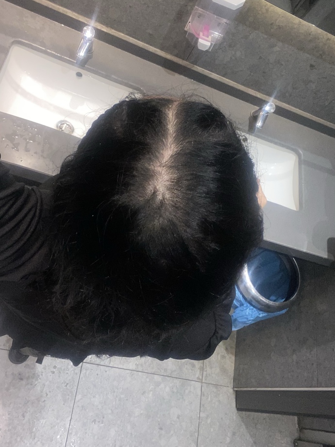 Saçım açılmış mı yoksa ayrım yeri olduğundan normal mi?