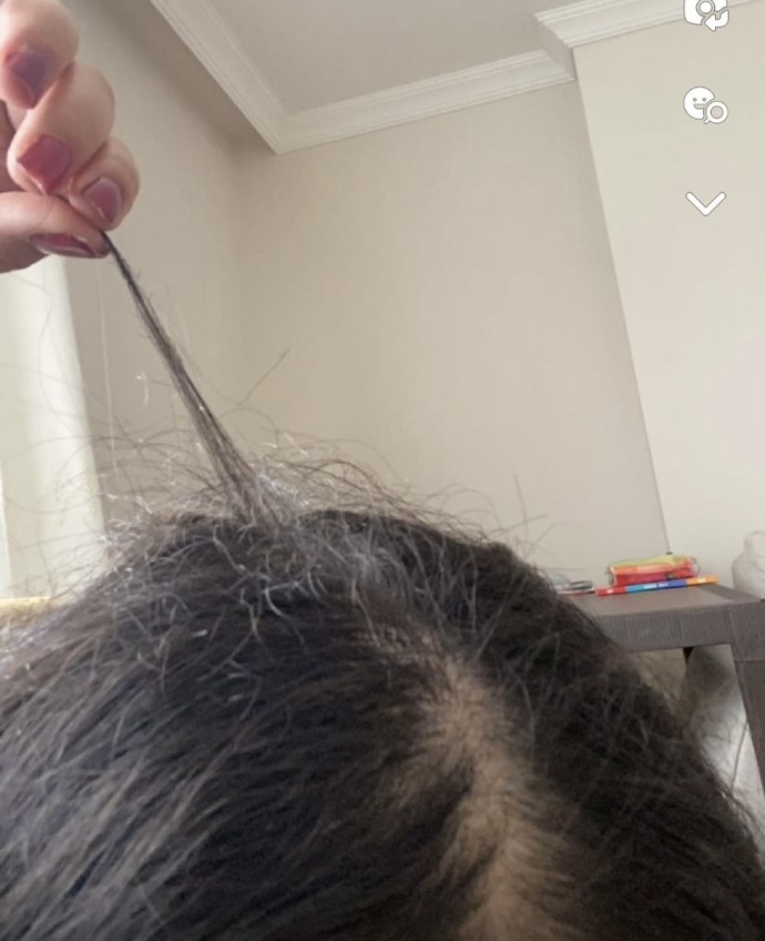 Benim niye buralardan saçım çıkıyo?