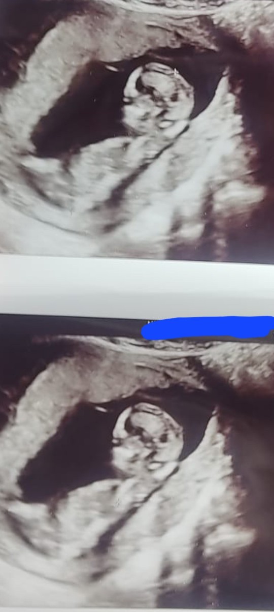 Ultrason resminden bebeğin cinsiyeti anlaşılır mı?