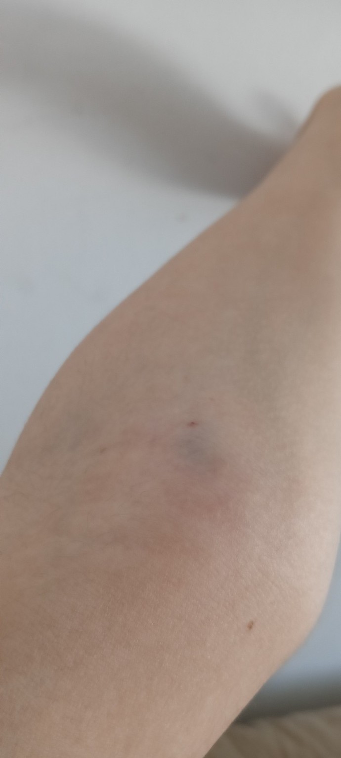 Kan verdikten sonra şişti ve morardı, normal mi?