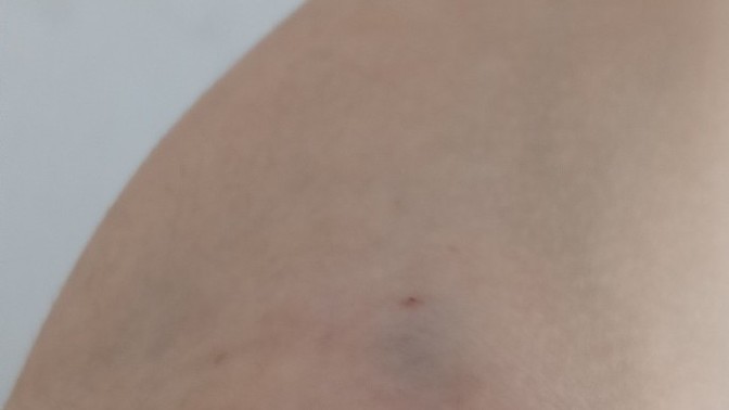 Kan verdikten sonra şişti ve morardı, normal mi?