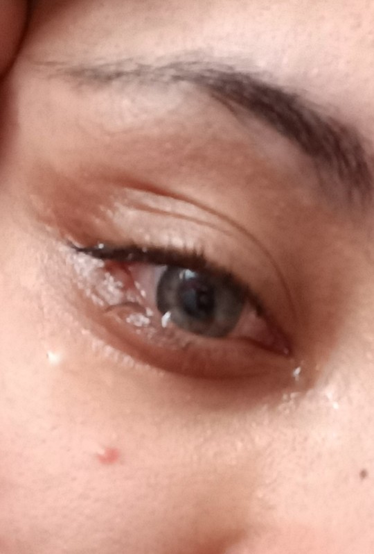 Lens gözümde kaldı, çıkmıyor ve gözüm acıyor. Ne yapabilirim 😭?