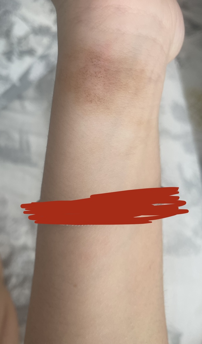 Sabah uyandığımda bileğimde iz vardı, neden böyle oluyor?