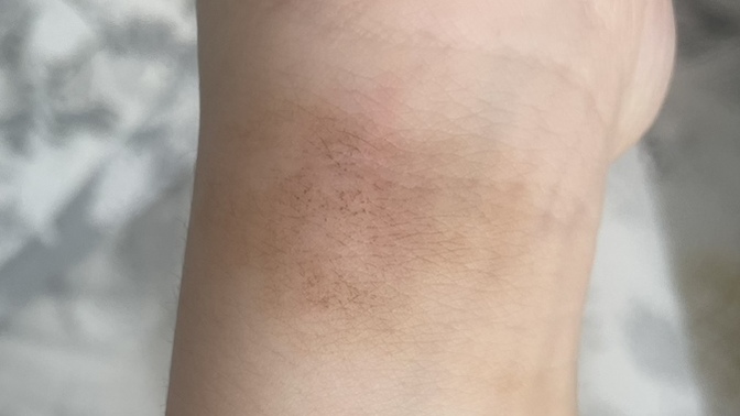 Sabah uyandığımda bileğimde iz vardı, neden böyle oluyor?