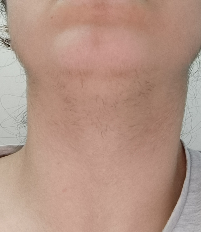 Kızım ama boynumda kıllar cikiyo?
