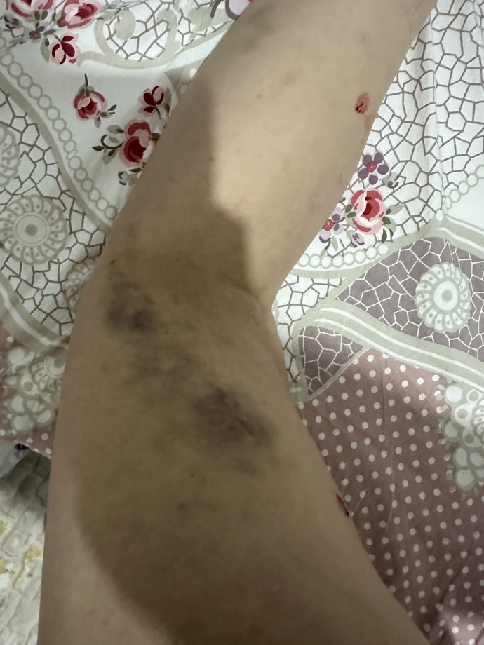 Vücudumda kocaman morluklar çıkıyor sizce neden?