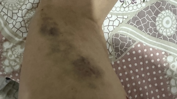 Vücudumda kocaman morluklar çıkıyor sizce neden?