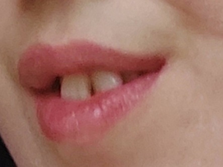 Ön dişlerim böyle çarpık ve tavşan. Evde mi kaldım?