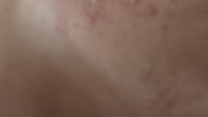Bu sivilceler ve izleri hangi kremi kullanırsam geçer?