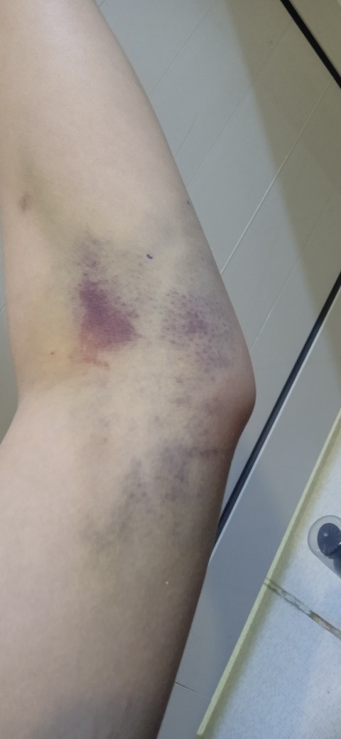Kan verdikten sonra kolumun böyle olması normal mi?