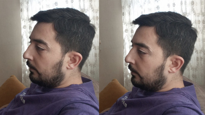 Burnum biraz kemerli ve büyük. Sizce burnumu yaptırayım mı?