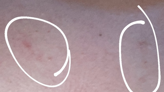 Vücudumda pembe benekler çıktı, uyuz olmuş olabilir miyim?