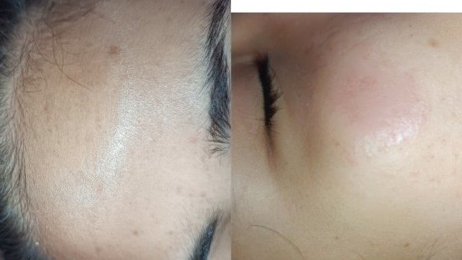 Cildimdeki lekeleri nasıl giderebilirim, önerebileceğiniz serum ya da kremler var mı?