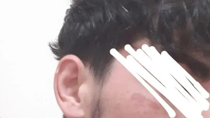 Ağda yanığı nasıl geçer?