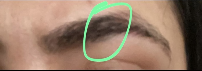 Burada boşluk mu oluşmuş yoksa yağlı egzema mı?