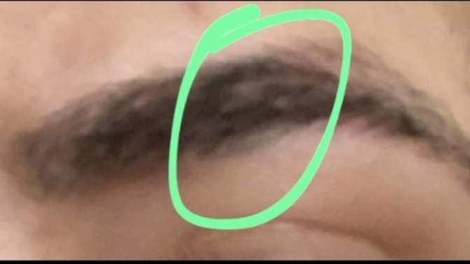 Burada boşluk mu oluşmuş yoksa yağlı egzema mı?