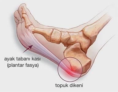 Düz taban ağrısı nasıl geçer😒?