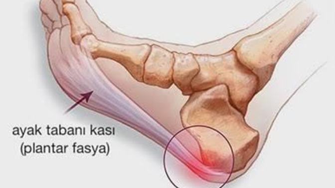 Düz taban ağrısı nasıl geçer😒?