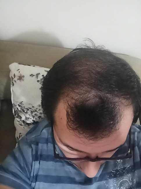 Saçlarınız gür mü seyrek mi?
