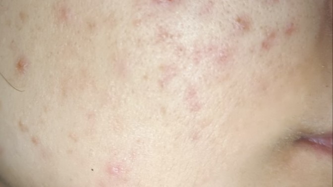 Sivilcelerim hafif mi, orta mı, şiddetli mi, nasıl geçer🥺?