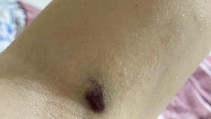 Kan verdikten sonra kolum inanılmaz bir şekilde morardı geçmezse diye korkuyorum ciddi bir şey mi sizce?