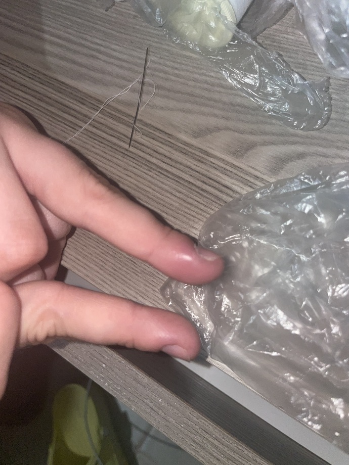 Parmağım dolama oldu, hastaneye gitmeli miyim?