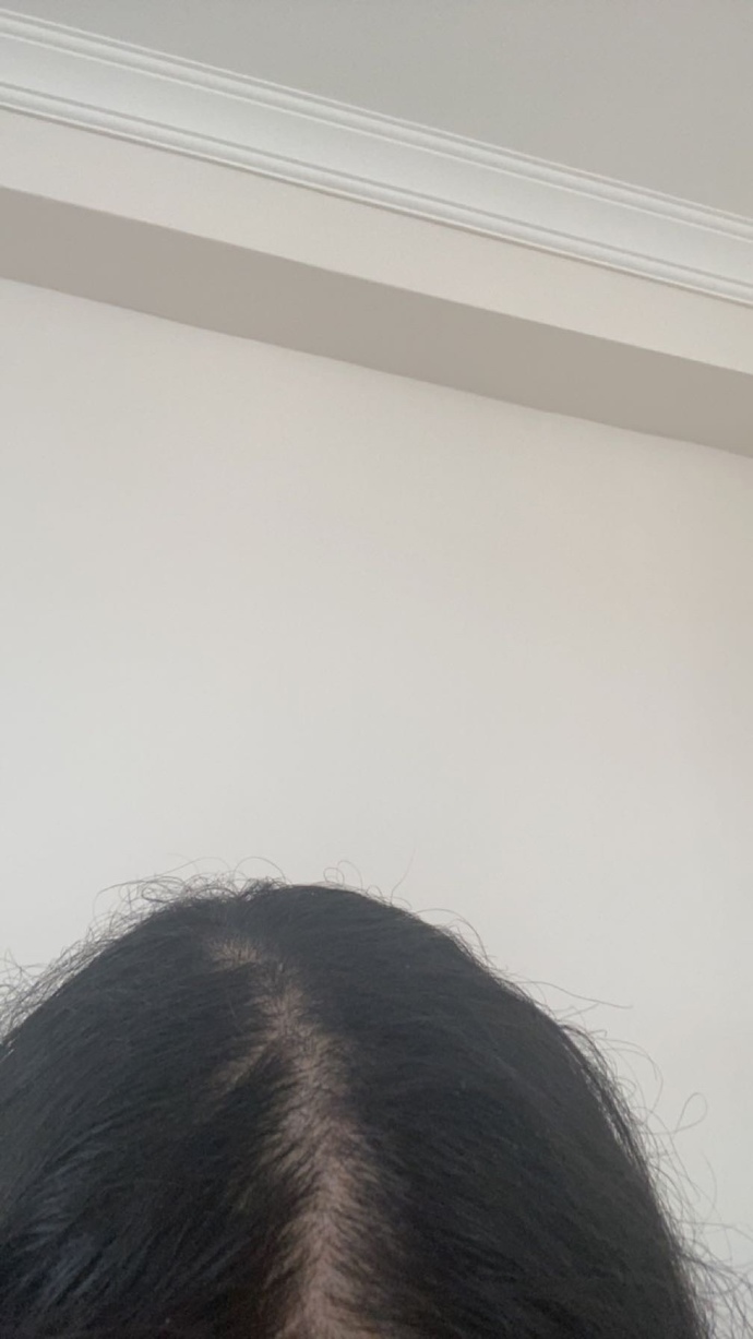 Saç çizgimin böyle olması normal mi?
