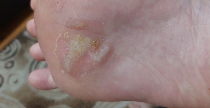 Ayağımda mantar var ne yapıcam?