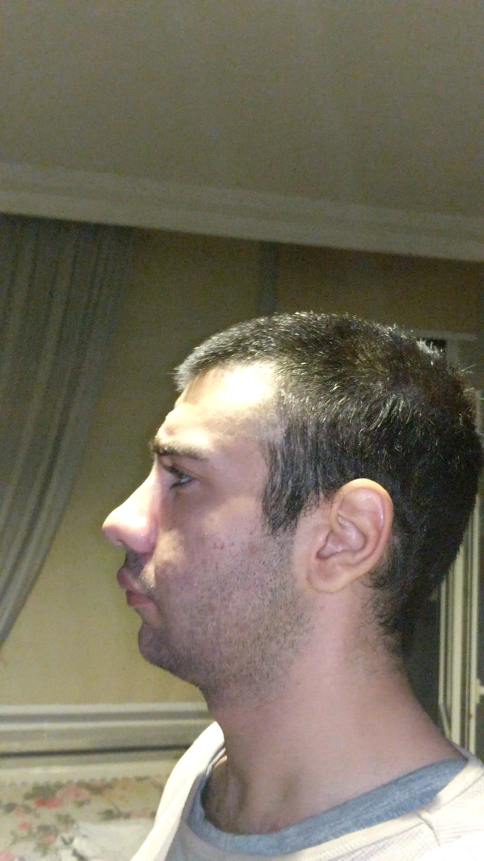 Yüzüm asimetrik sizce jawline yaptırsam mı?