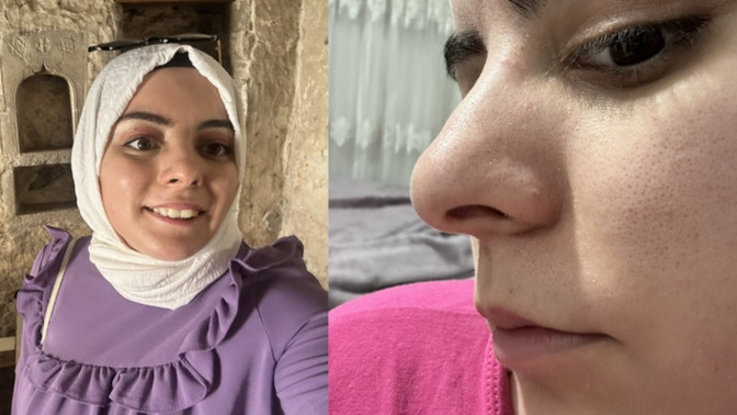 Burnum güzel mi, burun ameliyatı olmak istiyorum gerek var mı?