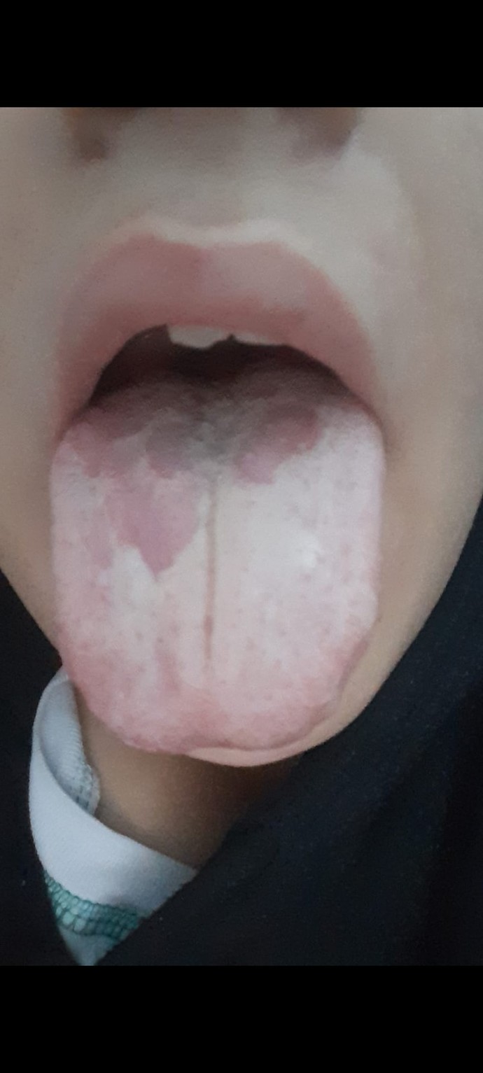 Dilim ve ağzım 4 aydır böyle bu durumu yaşayan var mı?