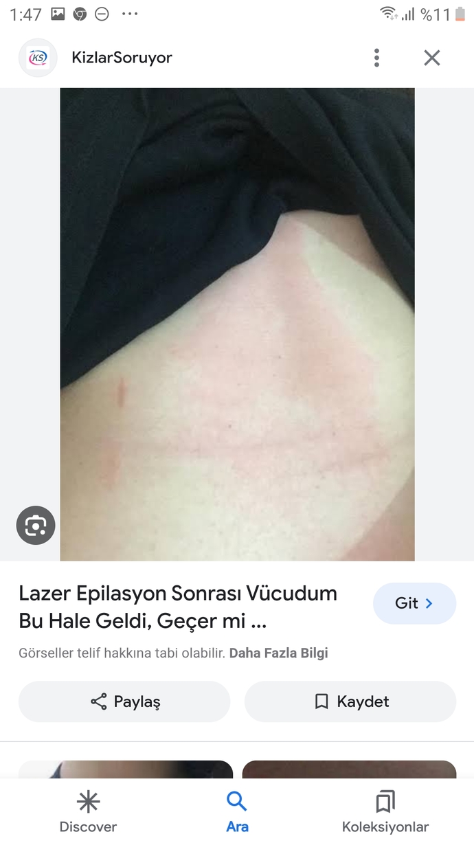 Kızlar vücudum kızarıyor, sizce nasıl geçer?