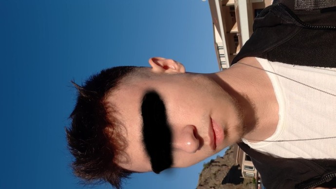 Yüzümü sivilce bastı, neden olabilir?