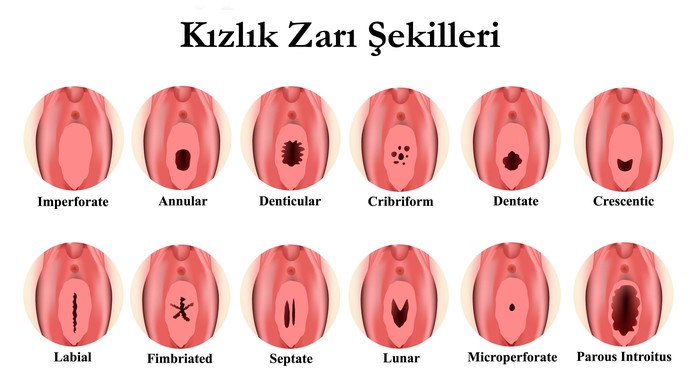 Kızlık zarında delik olurmuş doğru mu?