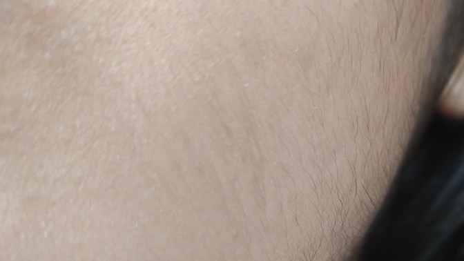 Yüzüm mahvoldu, ağdayla almıştım. Nasıl düzelir?