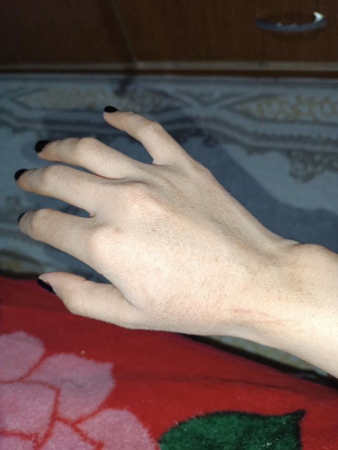 Zoretanin kullanıyorum, ellerim böyle oldu. Yüzümde hiç bir değişiklik yok, kurumadı bile. Nedendir?