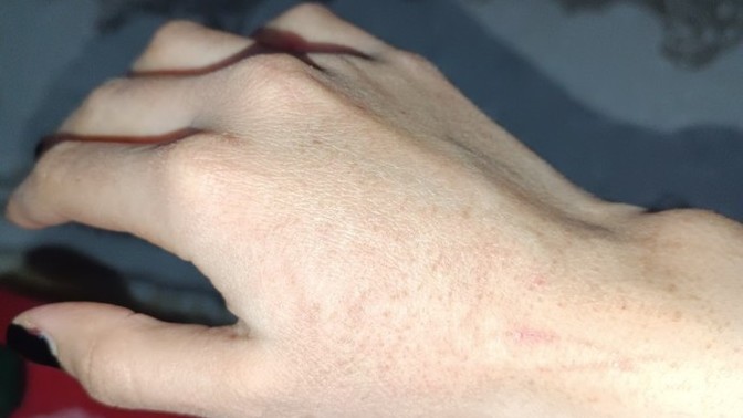 Zoretanin kullanıyorum, ellerim böyle oldu. Yüzümde hiç bir değişiklik yok, kurumadı bile. Nedendir?