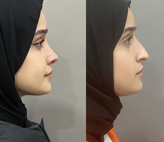 Yaygınlaşan burun estetiği hakkında ne düşünüyorsunuz ve resimdekiler için hangi halleri daha hoş?